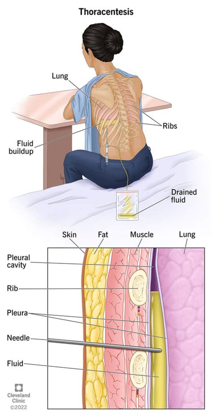 Are you awake during a thoracentesis