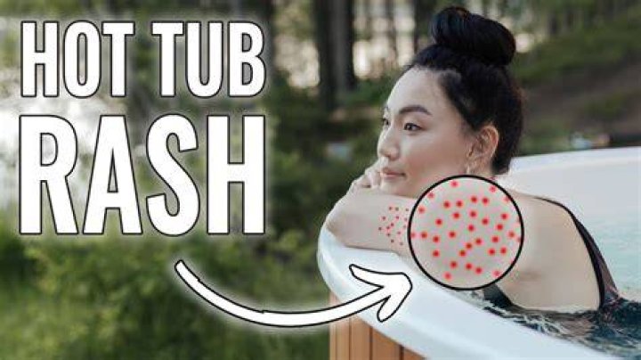 Can a hot tub cause itching