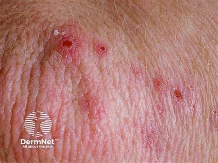 Can dermatitis herpetiformis appear on the face