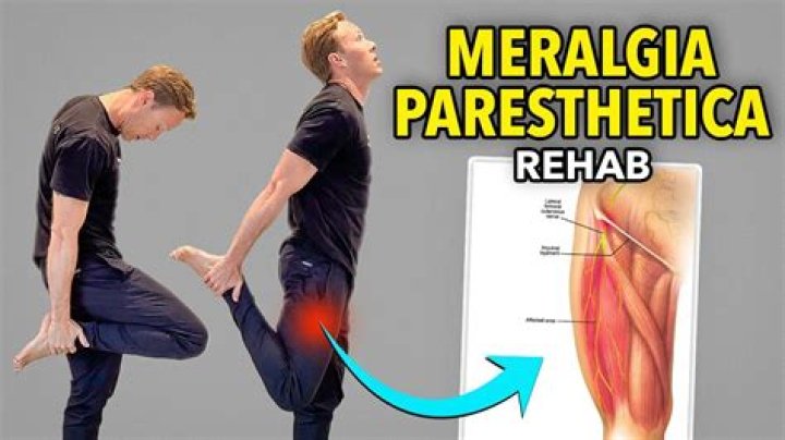 Can I workout with meralgia paresthetica?