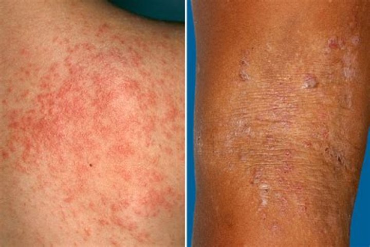Can mass hysteria cause a rash