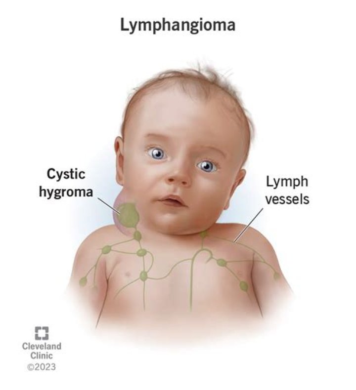 Can newborns get swollen lymph nodes