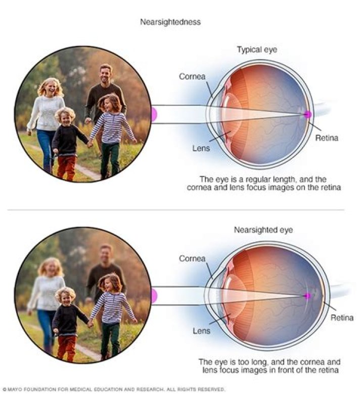 Can you have nearsightedness and farsightedness
