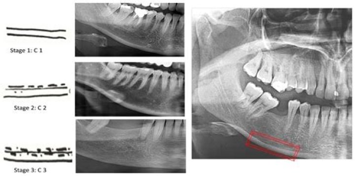 Can you see bone loss on an X-ray?