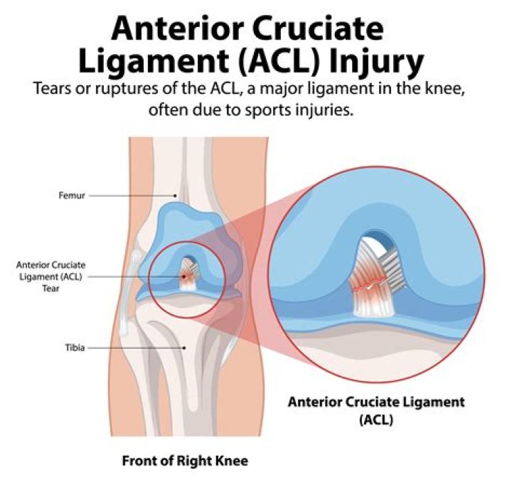 Can you tear your ACL and PCL