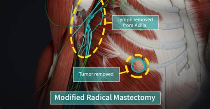 Do mastectomy bras stay in place?