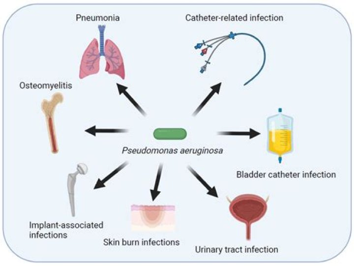 Does Pseudomonas aeruginosa cause pneumonia?
