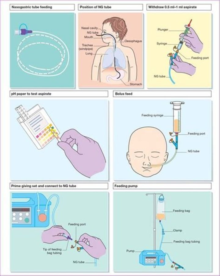 How can you prevent aspiration during enteral tube feeding a nurse