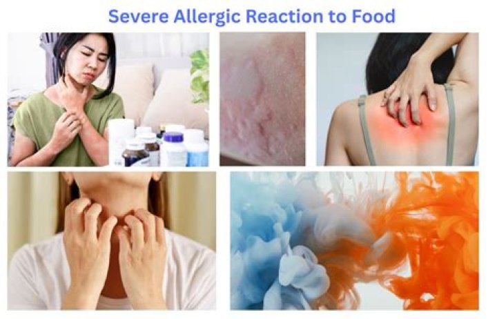 How do you treat an allergic reaction to grass