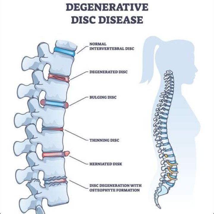 How fast does degenerative disc disease progress in dogs