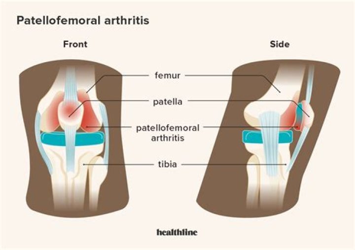 How is patellofemoral arthritis treated