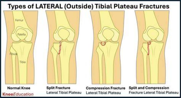 How long does a non displaced knee fracture take to heal?