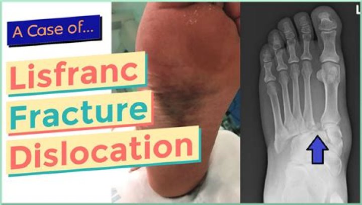 How long does it take to recover from a Lisfranc fracture