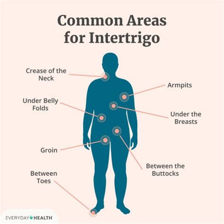 How would you describe intertriginous dermatitis?