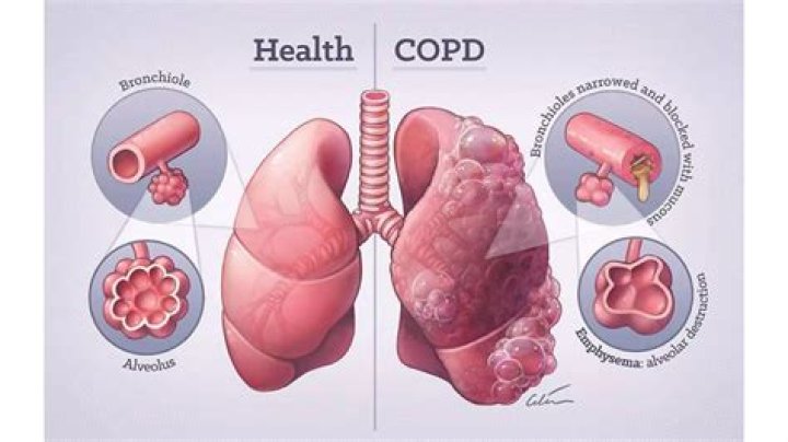 Is boswellia good for COPD