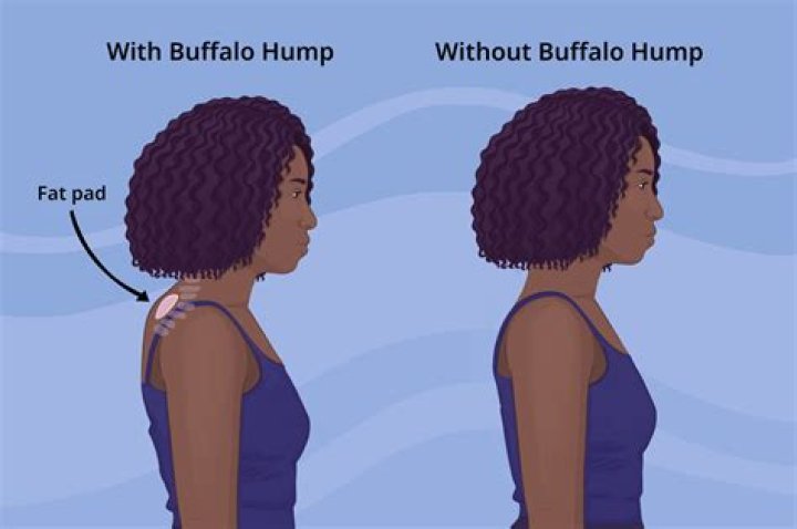 Is it normal to have a bump on the back of your neck spine?