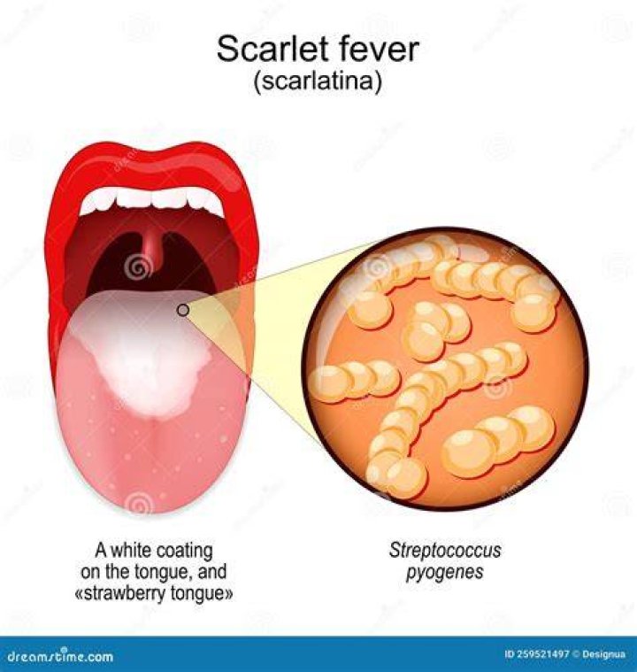 Is there a difference between scarlet fever and scarlatina?