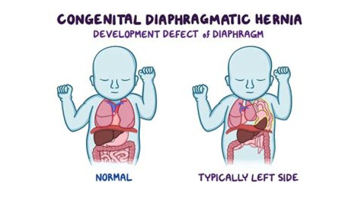 What are the symptoms of a diaphragmatic hernia