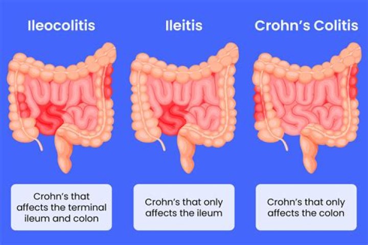 What can cause ileitis