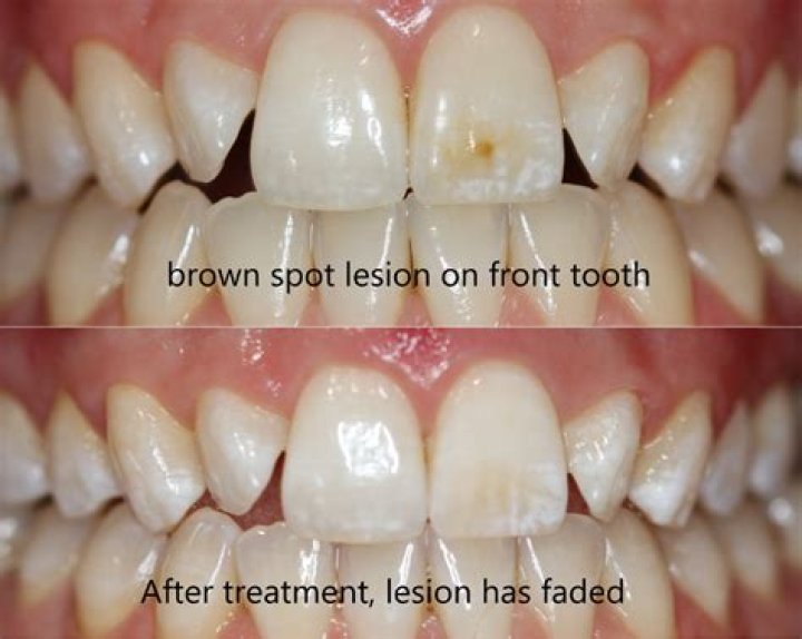 What causes brown spots on baby teeth
