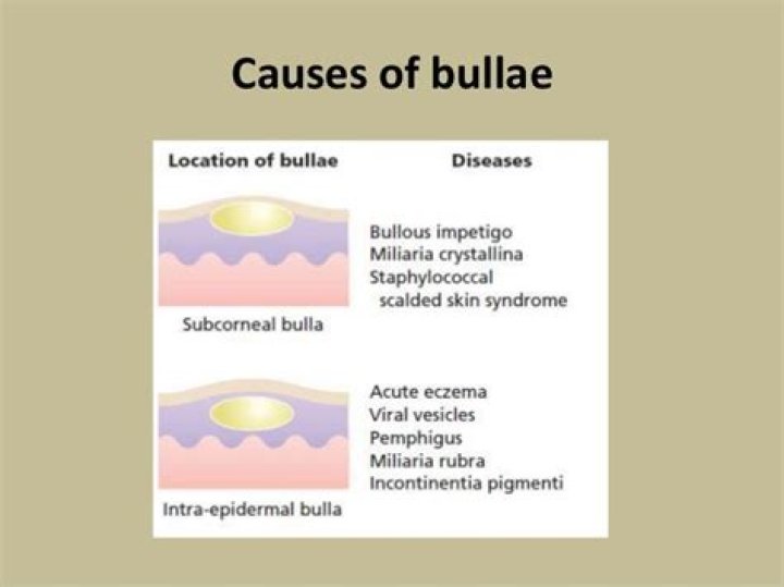 What causes bullae on the skin