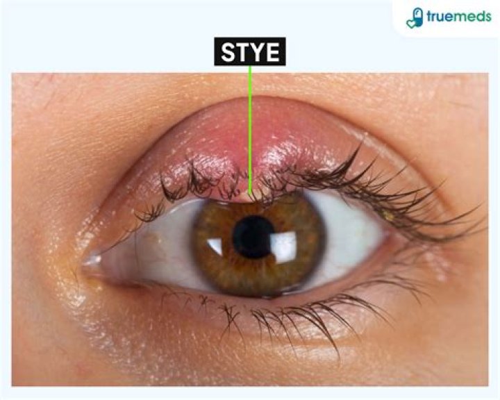 What does an eye stye look like?