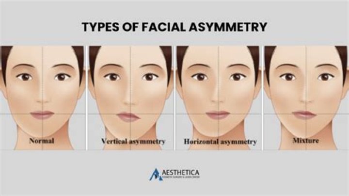 What does asymmetry mean in medical terms