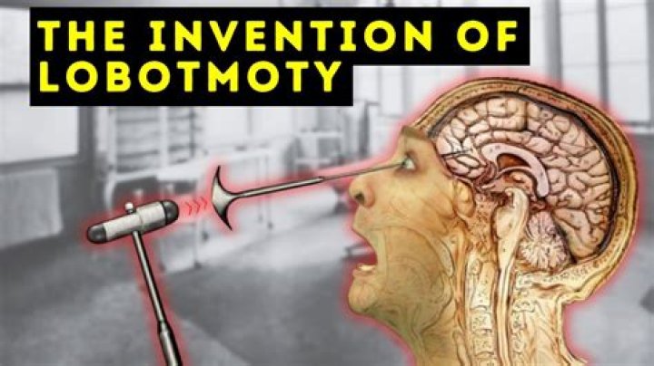 What does lobotomy mean in psychology