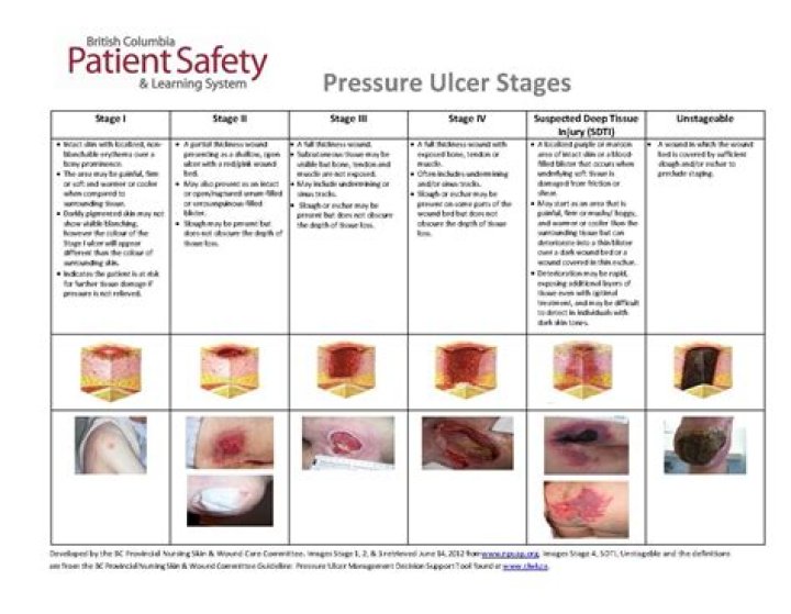 What is a Category 1 pressure ulcer