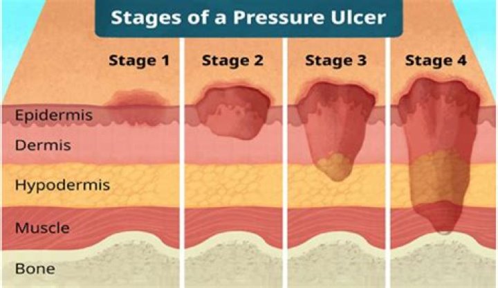 What is a grade 4 pressure ulcer