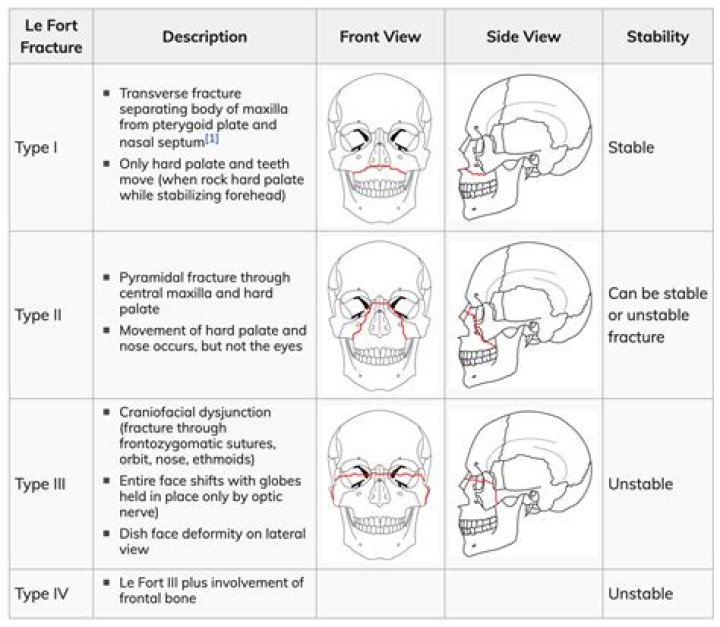 What is a LeFort 2 fracture