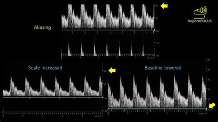 What is aliasing in Doppler ultrasound
