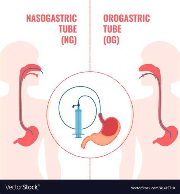 What is an OG tube placement?