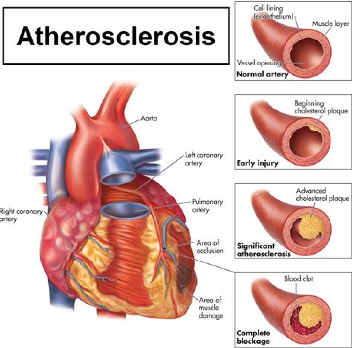 What is atherosclerosis of native coronary artery of native heart without angina pectoris