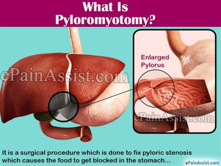 What is Pyloromyotomy surgery