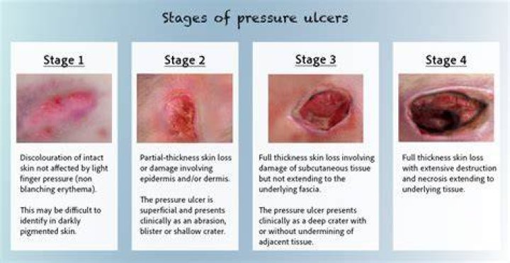 What is the difference between a pressure sore and an ulcer