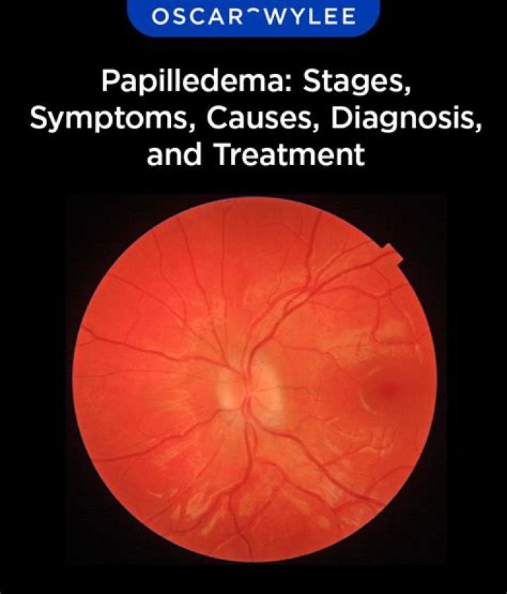 What is the most common cause of papilledema