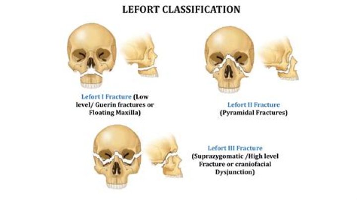 What kind of fracture is a complete craniofacial separation