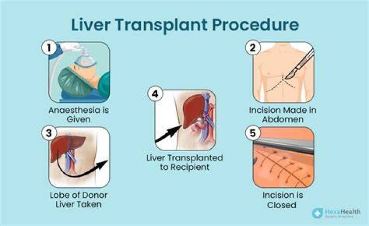 What qualifies you for a liver transplant?