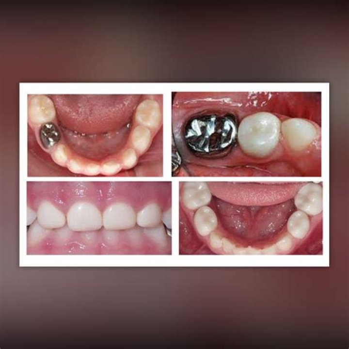 Why do pediatric dentists have stainless steel crowns