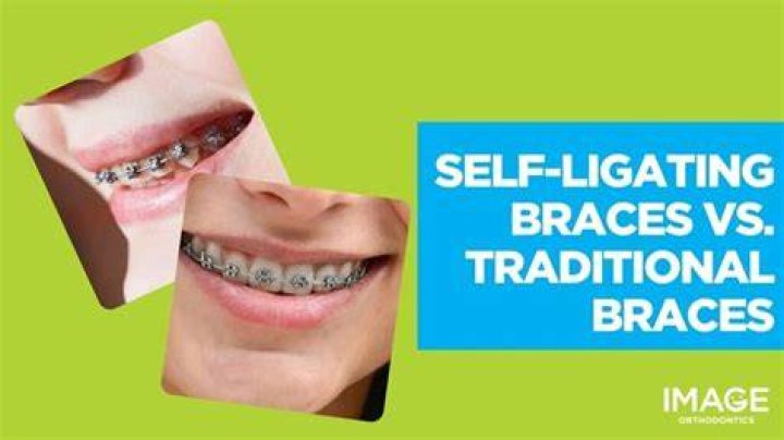Why do some doctors prefer self-ligating brackets?