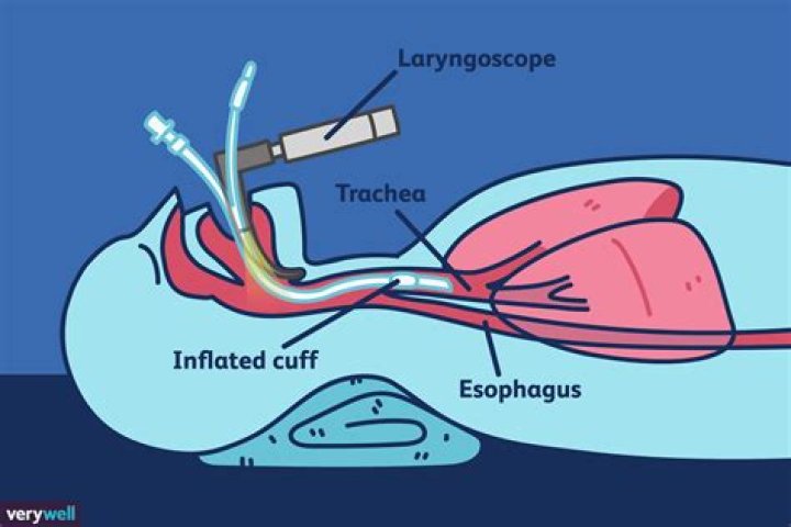 Why would it be hard to intubate someone?