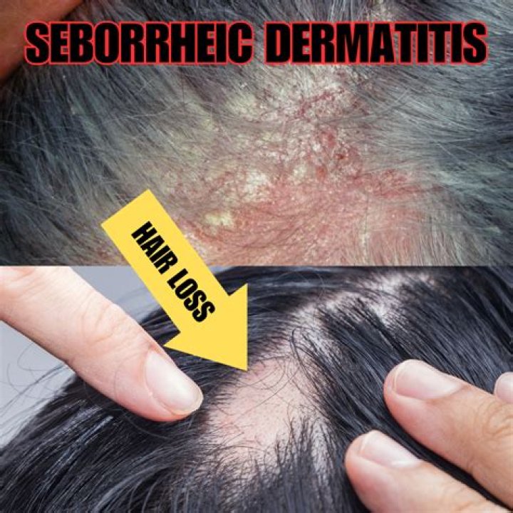 Will hair grow back after seborrheic dermatitis
